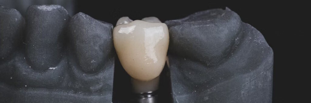 Dental implant 1